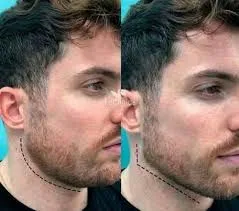 Masculinización facial: definición, precisión médica y resultados elegantes